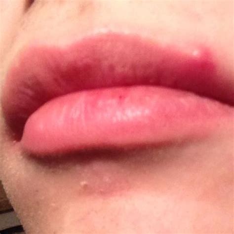 Pickel an der Lippe, Hilfe! (Beauty, Party, Style)