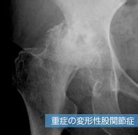 股関節の病気（変形性股関節症） - 診療する疾患のご案内 ...
