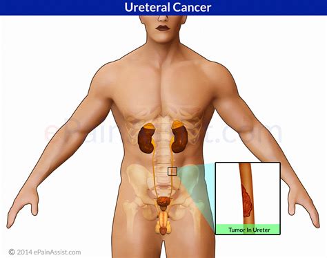 Related online courses on physioplus. Ureteral Cancer or Ureter Cancer or Renal Pelvis Cancer ...