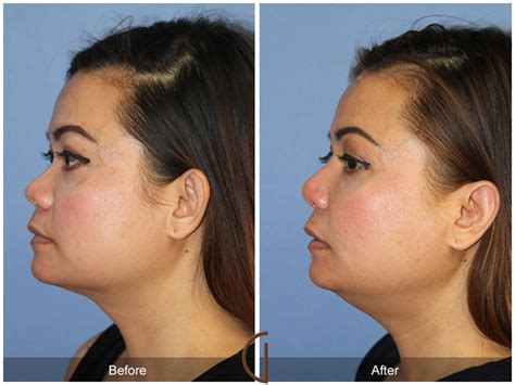 Maybe you would like to learn more about one of these? Rhinoplasty 103 Before After Photos Orange County