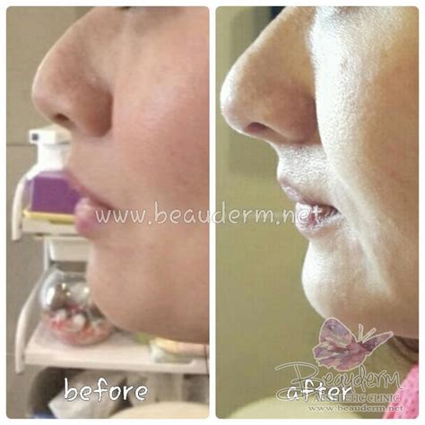 Anda sulit bernapas dengan lega karena. Gallery Filler Hidung / Nose Filler Before After