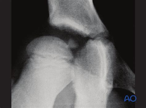 We did not find results for: 31-E/8 - Intraarticular flake(s)