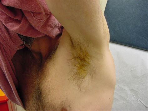 Additionally, there are networks of lymph nodes in this area, which can swell up when your body is trying to fight off an infection. 33 Best Pictures Infected Hair Armpit - What Are The Signs ...