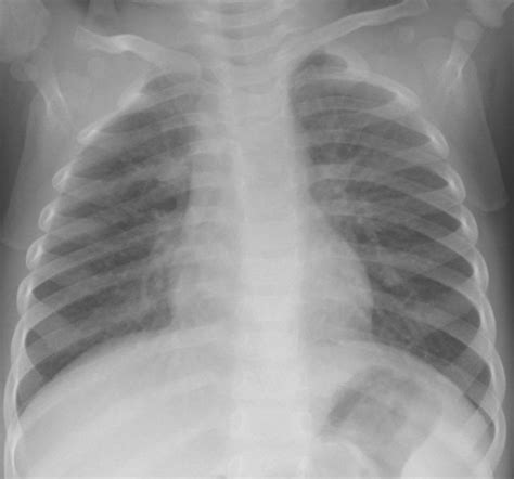 Rsウイルス = respiratory syncytial virus。 診断. こどもの病気・おとなの病気:RSウイルス感染症(5)(6)(細気管支炎)