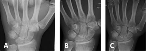Early diagnosed group. a X-ray shows a fracture of the ...