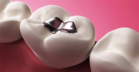 Do you know how much new teeth cost? What is Tooth Filling? Types of Filling and how Much does ...