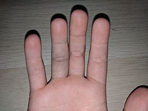 Read on to discover some exercises that may alleviate the symptoms of trigger finger. Jammed finger - Wikipedia