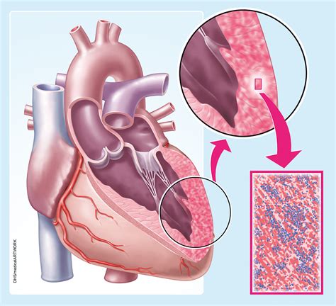 Myocarditides) is a general term referring to inflammation of the myocardium. Herzmuskelentzündung (Myokarditis) wird bei Kindern häufig ...