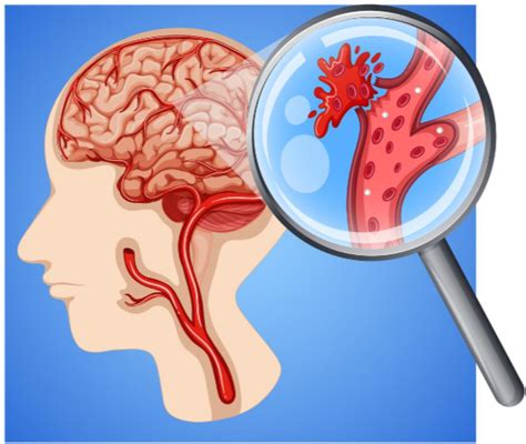 Learn about brain aneurysm, a type of defective blood vessel in the brain. Exercise Guidelines after Brain Aneurysm Coiling or Clipping » Scary Symptoms