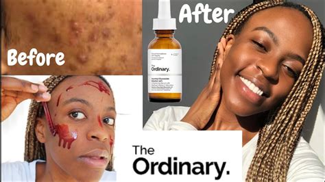 Niod + the ordinary hyperpigmentation and melasma treatment reviews. SKIN | How To Get Rid of Acne & hyperpigmentation Using ...