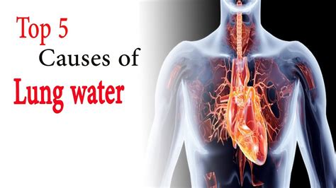 How to prepare for a thoracentesis when preparing a person for a thoracentesis, a doctor may: Water in lungs causes | Top 5 causes of lung water - YouTube