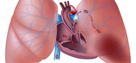 Markery jsou příznaky spojené se zvýšenou pravděpodobností plicní embolie. Plicní embolie » Medixa.org