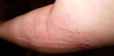 Hives is a skin rash that can cause the skin to be red and have itchy bumps. Natural Treatment Of Hives, improvement within 24 hours with homeopathy