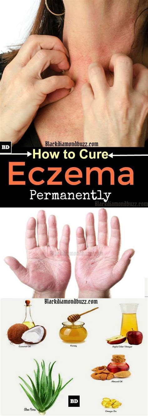 Check spelling or type a new query. How to Cure Eczema Permanently - 10 Home Remedies for ...