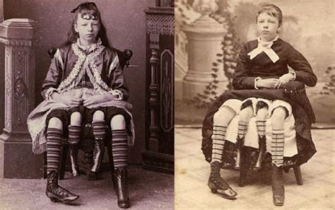 And she was known as the four legged woman. Josephine Myrtle Corbin: conheça a história da mulher com ...