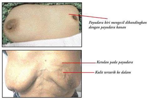 Wanita diantara umur 45 dan 55 tahun berada dalam kategori paling berisiko. Januari 2013 | Download Percuma