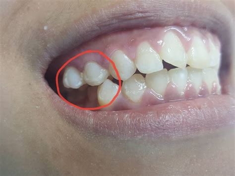 Selepas tu mula laa membeli segala barang untuk penjagaan gigi. Saya Tanya Kenapa Sejak Pakai Braces, Gigi Saya Sakit Dan ...