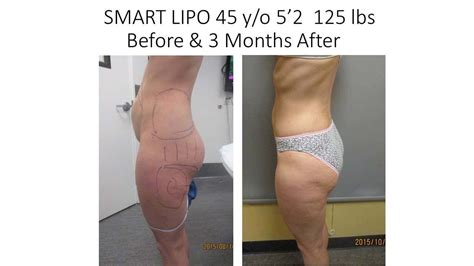 How much does it cost to have a p.o. Smart Liposuction Before and After Photos | Laser Lipo ...