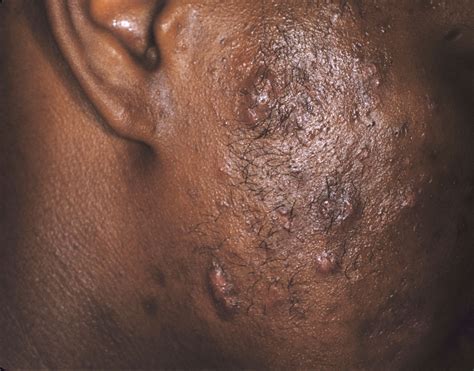 Take a look at these pictures depicting deep cysts. Skin Conditions That Cause Pimples