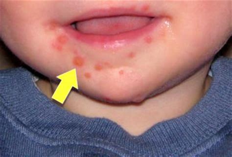 It is an early indication in most cases and occurs within two to three weeks after you have contracted the virus. THIS is Why You Should Never Let Anybody Kiss Your Baby on ...