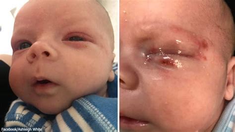 Fatal organ damage, including the liver, lungs, and heart serious viral infections, such as viral meningitis recurrent sores on the skin, eyes, genitals, or mouth Mom Posts Urgent Warning After Son Catches HSV-1 at His ...