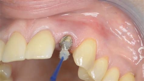 Make sure any residue (temporary cement, desensitizers, astringents, disinfectants, etc.) is completely removed. Cementation of a Lava™ all zirconia crown using RelyX ...