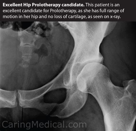 Nonsurgical treatments include medication and going to a chiropractor. When you have a painful hip and your MRI shows nothing ...