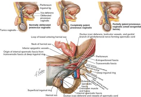 Find out all about groin injury : Groin Masses | Anesthesia Key