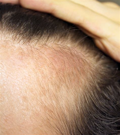 I'm new to this forum. Setipiprant For Hair Loss - Mega Thread | Page 7 ...