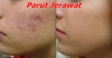 Maybe you would like to learn more about one of these? 7 Cara Mudah Hilangkan Parut Jerawat Secara Semulajadi ...