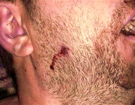 Jan 11, 2021 · dimaio: Pathology Outlines - Gunshot wounds