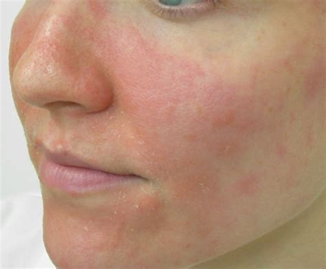 Common causes are soap, bleach, cleaning agents, chemicals, and even water. Facial Eczema: Triggers and Dealing Methods | New Health ...