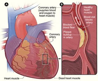 Saluran pembuluh darah tersumbat atau yang disebut atherosklerosis adalah terjadinya penyempitan pembuluh darah dikarenakan adanya sumbatan pada jaringan pembuluh darah berupa lemak yang berlebihan, sehingga aliran darah ke berbagai organ tubuh menjadi terganggu. RedzWANG: DOA UNTUK RAWATAN SAKIT JANTUNG, SALURAN DARAH ...