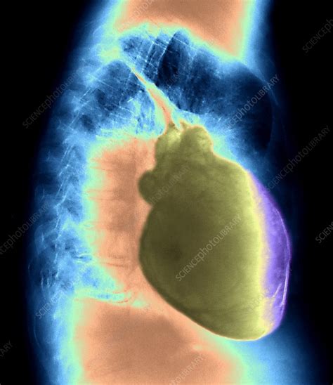 Myocardial infarction, acute myocarditis, cardiac tamponade (and other causes leading to a acute weakening of the contractility of. Heart inflammation, X-ray - Stock Image - M172/0518 ...