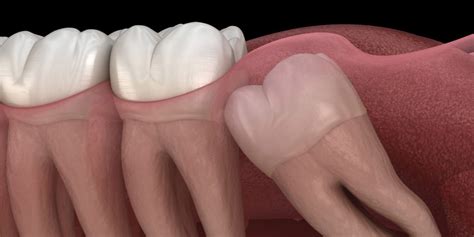 From wikimedia commons, the free media repository. Why do Wisdom Teeth Need to be Removed? - Top Rated ...