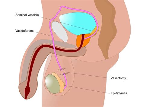 It comes with two tests and is. Vasectomy Procedure, How It Is Done | Mla Guide To Health