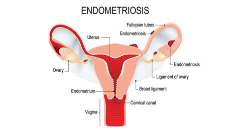 Pathogenetic implications of the anatomic distribution. Endometriosis: The 4 Stages & Treatment Options - Medicine.com