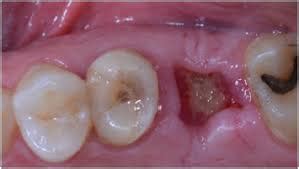 How should i sleep after wisdom teeth removal? What To Expect After a Wisdom Tooth Extraction