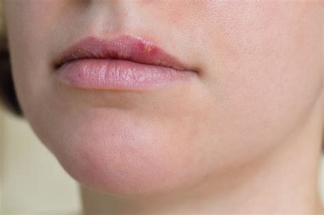 Découvrez comment faire partir un bouton de fièvre grâce à vos pharmaciens en ligne ! Bouton de fièvre : la propolis peut-elle le faire ...