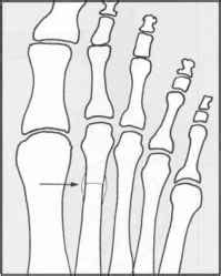 Green Stick Fracture Treatment - Fracture Treatment
