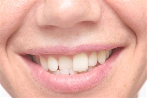 Why you should fix crooked teeth. A Few Important Facts About Crooked Teeth | Woodland Hills, CA