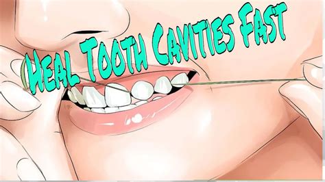 However, it's been proven that there are ways to reverse cavities naturally. How to Heal Dental Cavities-HOW TO REVERSE CAVITIES AND ...