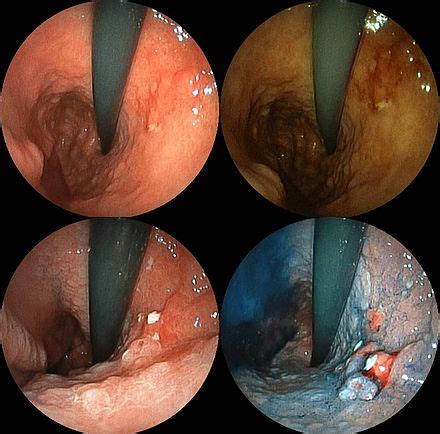 As with any cancer, routine screening or identifying the early signs of cancer are key to early. Stomach cancer - Wikipedia