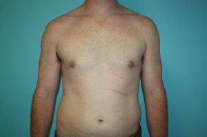 One of this is the skill or experience of the surgeon in doing this type of in most cases, male breast reduction surgery is not among the medical or surgical procedures covered by health insurance policies since it is viewed. Gynecomastia Photos - Hanemann Plastic Surgery