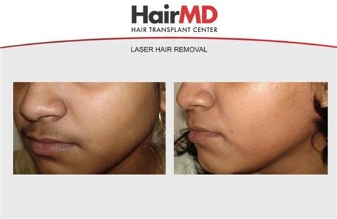 The light from the laser then heats the hair follicle to a point where it becomes damaged, resulting in no growth at all or hair that's much finer. Pin on Laser Hair Removal : Results & Before and After ...