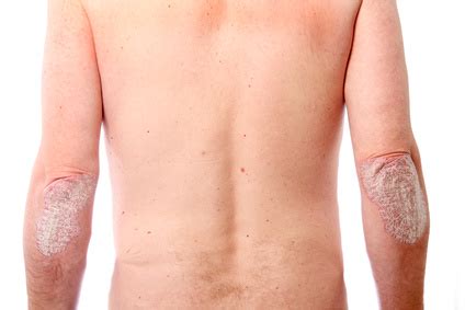 Die schwellung ist meist einseitig im hinteren drittel der schamlippe und kann hühnereigroß werden. - Schuppenflechte (Psoriasis), Informationen und Tipps zur ...