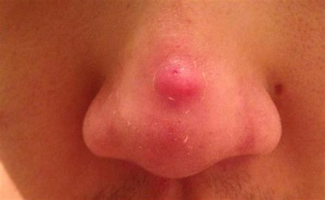 Body piercing bump types with images. How to Get Rid of Pimples on Nose Fast and Overnight?