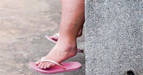 Das lipödem tritt (fast) nur bei frauen auf. Dicke Beine, machtlose Frauen - wie sich eine Schweizer ...