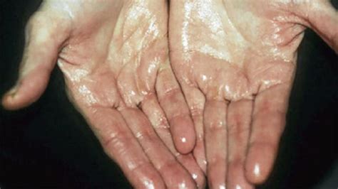 Bayi berpeluh dengan banyak setiap kali waktu menyusu? Tangan Korang Kerap Berpeluh Tak? Kalau Ya, Mungkin Korang ...
