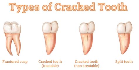 Read on to find out! Answered: 6 Most Common Questions on Cracked Tooth